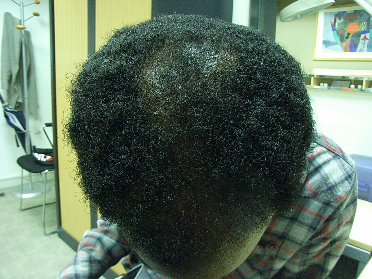 The Hair Centre Black Hair Loss Treated Male Photos