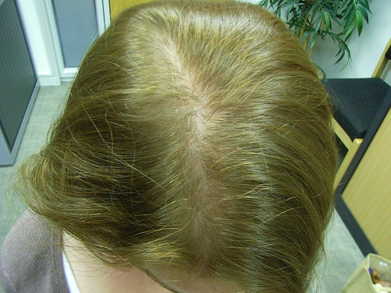 The Hair Centre Female Hair Loss Treated Photos