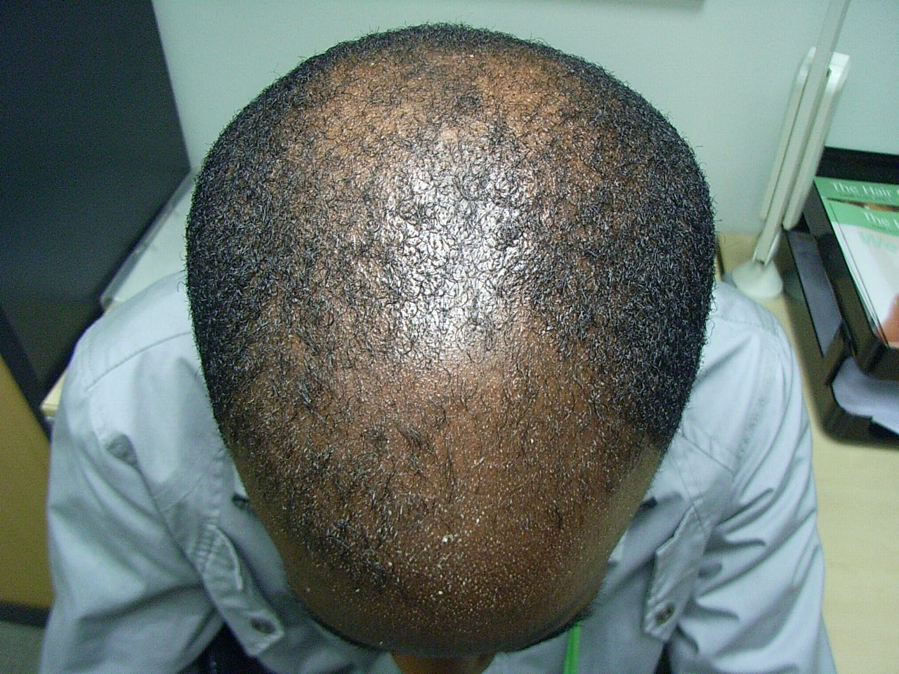 the hair centre | black hair loss treated (male) photos