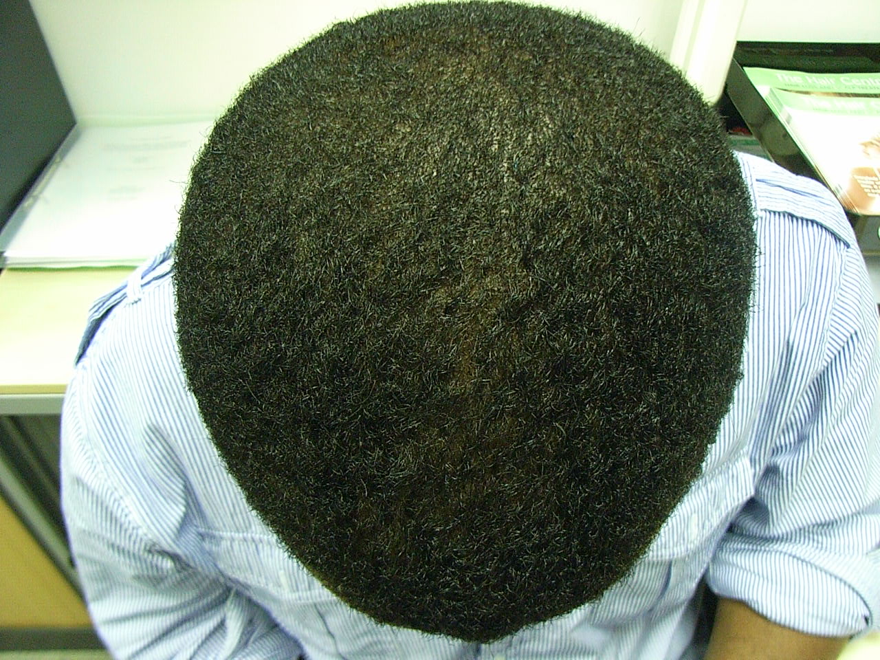 the hair centre | black hair loss treated successfully in